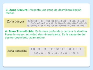 3. Zona Oscura: Presenta una zona de desmineralización
menor.
4. Zona Translúcida: Es la mas profunda y cerca a la dentina.
Posee la mayor actividad desmineralizante. Es la causante del
desmoronamiento adamantino.
 