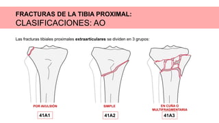 FRACTURAS DE LA TIBIA PROXIMAL:
CLASIFICACIONES: AO
Las fracturas tibiales proximales extraarticulares se dividen en 3 grupos:
POR AVULSIÓN
41A1
SIMPLE
41A2
EN CUÑA O
MULTIFRAGMENTARIA
41A3
 