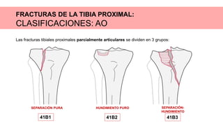 FRACTURAS DE LA TIBIA PROXIMAL:
CLASIFICACIONES: AO
Las fracturas tibiales proximales parcialmente articulares se dividen en 3 grupos:
SEPARACIÓN PURA
41B1
HUNDIMIENTO PURO
41B2
SEPARACIÓN-
HUNDIMIENTO
41B3
 