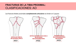 FRACTURAS DE LA TIBIA PROXIMAL:
CLASIFICACIONES: AO
Las fracturas tibiales proximales completamente articulares se dividen en 3 grupos:
ARTICULAR SIMPLE,
METAFISARIA SIMPLE
41C1
ARTICULAR SIMPLE, EN CUÑA O
METAFISARIA
MULTIFRAGMENTARIA
41C2
FRAGMENTARIA O
MULTIFRAGMENTARIA
METAFISARIA
41C3
 