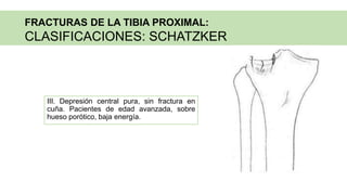 III. Depresión central pura, sin fractura en
cuña. Pacientes de edad avanzada, sobre
hueso porótico, baja energía.
FRACTURAS DE LA TIBIA PROXIMAL:
CLASIFICACIONES: SCHATZKER
 