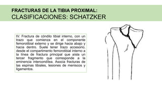 IV. Fractura de cóndilo tibial interno, con un
trazo que comienza en el componente
femorotibial externo y se dirige hacia abajo y
hacia dentro. Suele tener trazo accesorio,
desde el compartimento femorotibial interno a
la línea de fractura principal que aísla un
tercer fragmento que corresponde a la
eminencia intercondílea. Asocia fracturas de
las espinas tibiales, lesiones de meniscos y
ligamentos.
FRACTURAS DE LA TIBIA PROXIMAL:
CLASIFICACIONES: SCHATZKER
 