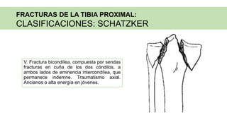V. Fractura bicondílea, compuesta por sendas
fracturas en cuña de los dos cóndilos, a
ambos lados de eminencia intercondílea, que
permanece indemne. Traumatismo axial.
Ancianos o alta energía en jóvenes.
FRACTURAS DE LA TIBIA PROXIMAL:
CLASIFICACIONES: SCHATZKER
 
