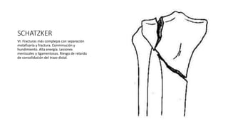 SCHATZKER
VI. Fracturas más complejas con separación
metafisaria y fractura. Conminución y
hundimiento. Alta energía. Lesiones
meniscales y ligamentosas. Riesgo de retardo
de consolidación del trazo distal.
 