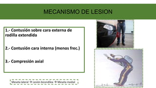 1.- Contusión sobre cara externa de
rodilla extendida
2.- Contusión cara interna (menos frec.)
3.- Compresión axial
Meseta lateral  Lesión bicondílea  Meseta medial
MECANISMO DE LESION
 