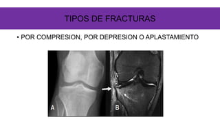 • POR COMPRESION, POR DEPRESION O APLASTAMIENTO
TIPOS DE FRACTURAS
 