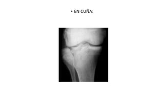 • EN CUÑA:
 