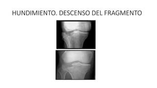 HUNDIMIENTO. DESCENSO DEL FRAGMENTO
 