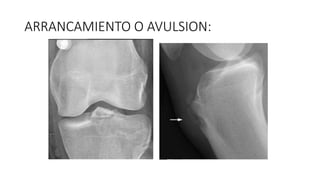 ARRANCAMIENTO O AVULSION:
 