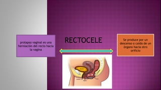 prolapso vaginal es una
herniación del recto hacia
la vagina
Se produce por un
descenso o caída de un
órgano hacia otro
orificio
RECTOCELE
 
