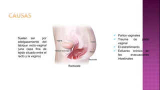 Suelen ser ​​por
adelgazamiento del
tabique recto-vaginal
(una capa fina de
tejido situada entre el
recto y la vagina)
 Partos vaginales
 Trauma de parto
vaginal
 El estreñimiento
 Esfuerzo crónico en
las evacuaciones
intestinales
 