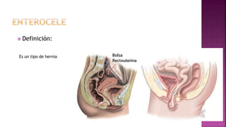 Definición:
Es un tipo de hernia
 