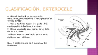 0.- Normal. Máximo 2 cm de excavación
retrouterina, peritoneo entre la parte posterior del
cuello y el recto.
1.- Hernia del fondo de saco a un punto o tres
cuartas partes de la distancia al himen.
2.- Hernia a un punto a dos cuartas partes de lo
distancia al himen.
3.- Hernia a un cuarto de la distancia al himen.
4.- Hernia hasta el himen.
Nota: El anillo himeneal es el punto final del
enterocele.
 