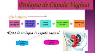 Tipos de prolapso de cúpula vaginal
Protrusión
del tejido
Sensación
de cuerpo
extraño
Dolor
dorsal
Incontinenci
aurinaria
Hemorragi
a
Prolapso de Cúpula Vaginal
Prolapso
vaginal
simple
Prolapso
vaginal
completo
 
