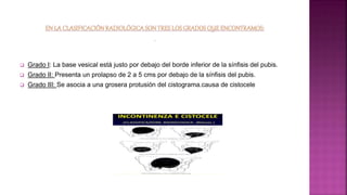  Grado I: La base vesical está justo por debajo del borde inferior de la sínfisis del pubis.
 Grado II: Presenta un prolapso de 2 a 5 cms por debajo de la sínfisis del pubis.
 Grado III: Se asocia a una grosera protusión del cistograma.causa de cistocele
 