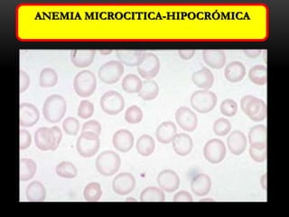 ANEMIA MICROCITICA-HIPOCRÓMICA

 
