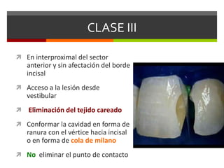 CLASE III
 En interproximal del sector
anterior y sin afectación del borde
incisal
 Acceso a la lesión desde
vestibular
 Eliminación del tejido careado
 Conformar la cavidad en forma de
ranura con el vértice hacia incisal
o en forma de cola de milano
 No eliminar el punto de contacto
 