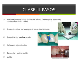 CLASE III. PASOS
 Abertura y eliminación de la carie con turbina, contrangulo y cucharilla y
conformación de la cavidad
 Protección pulpar con ionomero de vidrio si es necesario
 Grabado acido, lavado y secado
 Adhesivo y polimerización
 Composite y polimerización
 pulido
 