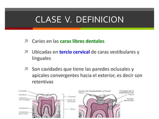 CLASE V. DEFINICION
 Caries en las caras libres dentales
 Ubicadas en tercio cervical de caras vestibulares y
linguales
 Son cavidades que tiene las paredes oclusales y
apicales convergentes hacia el exterior, es decir son
retentivas
 
