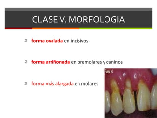 CLASEV. MORFOLOGIA
 forma ovalada en incisivos
 forma arriñonada en premolares y caninos
 forma más alargada en molares
 