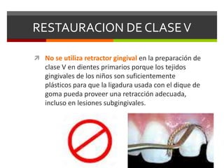RESTAURACION DE CLASEV
 No se utiliza retractor gingival en la preparación de
clase V en dientes primarios porque los tejidos
gingivales de los niños son suficientemente
plásticos para que la ligadura usada con el dique de
goma pueda proveer una retracción adecuada,
incluso en lesiones subgingivales.
 