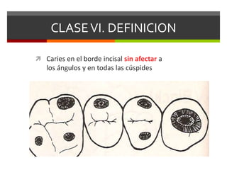 CLASEVI. DEFINICION
 Caries en el borde incisal sin afectar a
los ángulos y en todas las cúspides
 