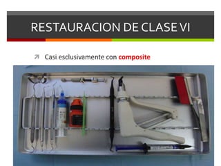 RESTAURACION DE CLASEVI
 Casi esclusivamente con composite
 