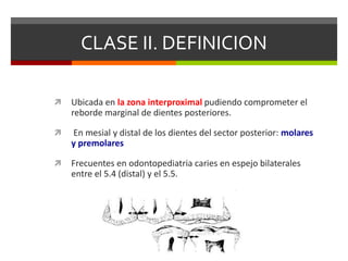 CLASE II. DEFINICION
 Ubicada en la zona interproximal pudiendo comprometer el
reborde marginal de dientes posteriores.
 En mesial y distal de los dientes del sector posterior: molares
y premolares
 Frecuentes en odontopediatria caries en espejo bilaterales
entre el 5.4 (distal) y el 5.5.
 