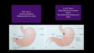 20% Tipo 3
Úlceras prepilórica
Hipersecreción de acido
5-10% Tipo 4
Parte alta de la curvatura
menor
Sin producción excesiva de
ácido
 