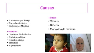 Causas
• Nacimiento por fórceps
• Distrofia miotónica
• Síndrome de Moebius
Genéticas:
• Síndrome de Goldenhar
• Diabetes mellitus
• Hipertiroidismo
• Embarazo
• Hipertensión
Tóxicas
• Tétanos
• Difteria
• Monóxido de carbono
 