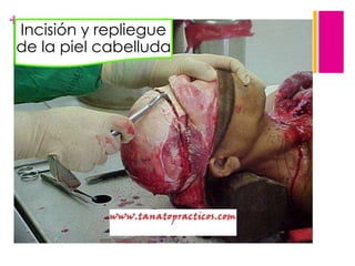 + Incisión y repliegue

de la piel cabelluda

 