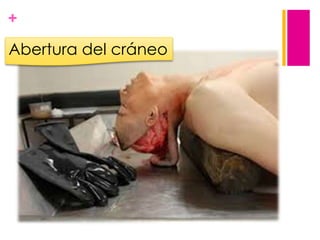 +

Abertura del cráneo

 