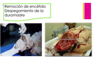 +Remoción de encéfalo
Despegamiento de la
duramadre

 