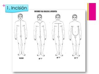 + 1. Incisión

 