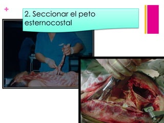 +

2. Seccionar el peto
esternocostal

 
