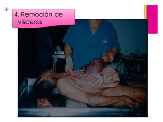 +

4. Remoción de
vísceras

 