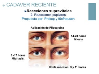 + CADAVER RECIENTE
Reacciones supravitales
2. Reacciones pupilares
Propuesta por: Prokop y fünfhausen
Aplicación de Pilocarpina
14-20 horas
Miosis

8 -17 horas
Midriasis.
Doble reacción: 3 y 11 horas

 