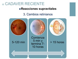 + CADAVER RECIENTE
Reacciones supravitales
3. Cambios retinianos

5-120 min

Comienza
5 min y
termina 710 horas

> 15 horas

 