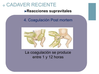 + CADAVER RECIENTE
Reacciones supravitales
4. Coagulación Post mortem

La coagulación se produce
entre 1 y 12 horas

 