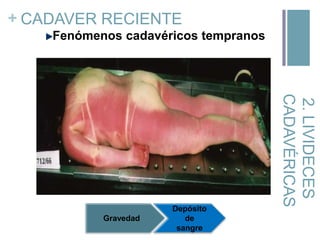 + CADAVER RECIENTE
Fenómenos cadavéricos tempranos

2. LIVIDECES
CADAVÉRICAS

Gravedad

Depósito
de
sangre

 
