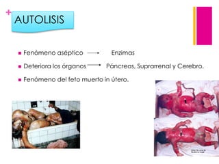 +

AUTOLISIS


Fenómeno aséptico

Enzimas



Deteriora los órganos



Fenómeno del feto muerto in útero.

Páncreas, Suprarrenal y Cerebro.

 