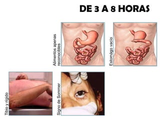 Signo de Sommer

Tibio y rígido

Estomágo vacío

Alimentos apenas
reconocibles

DE 3 A 8 HORAS

 