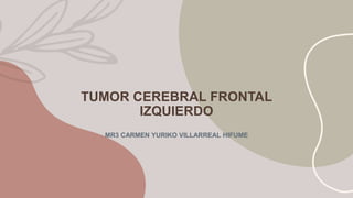 TUMOR CEREBRAL FRONTAL
IZQUIERDO
MR3 CARMEN YURIKO VILLARREAL HIFUME
 