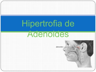 Hipertrofia de
Adenoides
 
