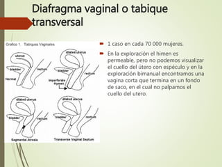 Diafragma vaginal o tabique
transversal
 1 caso en cada 70 000 mujeres.
 En la exploración el himen es
permeable, pero no podemos visualizar
el cuello del útero con espéculo y en la
exploración bimanual encontramos una
vagina corta que termina en un fondo
de saco, en el cual no palpamos el
cuello del utero.
 