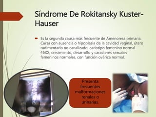 Síndrome De Rokitansky Kuster-
Hauser
 Es la segunda causa más frecuente de Amenorrea primaria.
Cursa con ausencia o hipoplasia de la cavidad vaginal, útero
rudimentario no canalizado, cariotipo femenino normal
46XX, crecimiento, desarrollo y caracteres sexuales
femeninos normales, con función ovárica normal.
Presenta
frecuentes
malformaciones
renales o
urinarias.
 