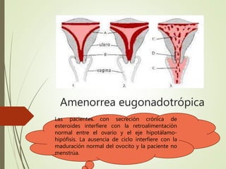 Amenorrea eugonadotrópica
Las pacientes con secreción crónica de
esteroides interfiere con la retroalimentación
normal entre el ovario y el eje hipotálamo-
hipófisis. La ausencia de ciclo interfiere con la
maduración normal del ovocito y la paciente no
menstrúa.
 