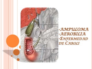 -AMPULOMA
-AEROBILIA
-ENFERMEDAD
DE CAROLI
 