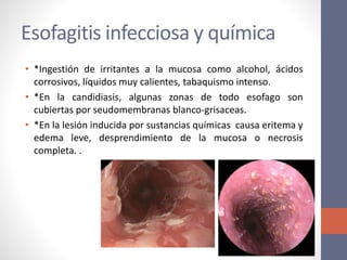 Anatomía patológica de esófago | PPTX