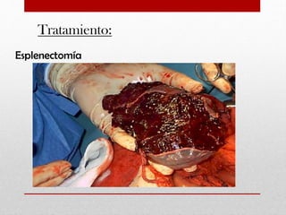 Tratamiento:
Esplenectomía

 
